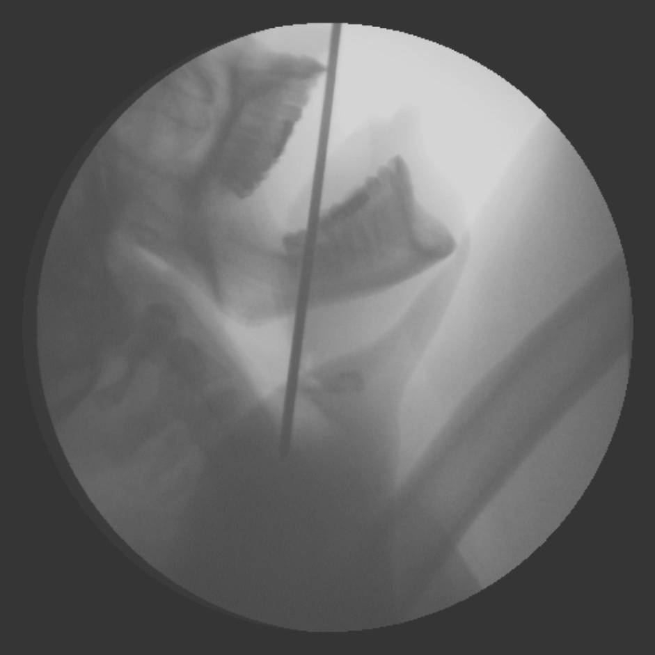 Dan Meyer lateral head x-ray, courtesy Dr. Edwin Donnelly, Vanderbilt Medical Center