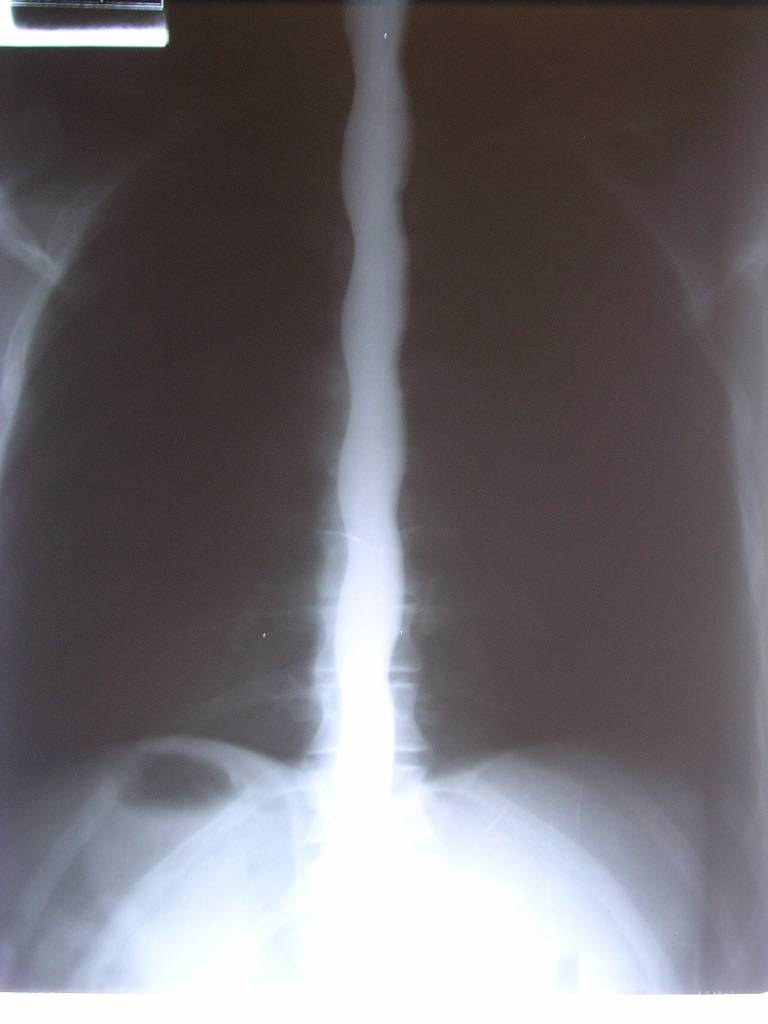 X-ray of Dan Meyer swallowing serpentine blade