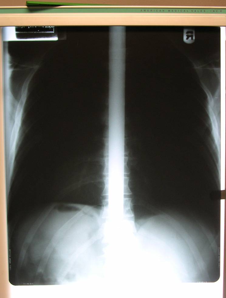 X-ray of Dan Meyer