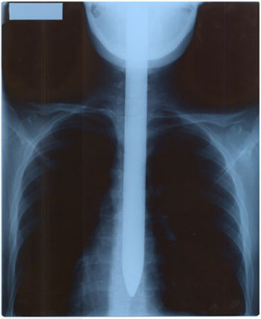 Roderick Russel X-ray