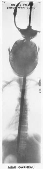 X-ray of Mimi Garneau