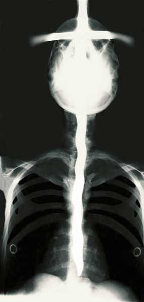 X-ray of Dai Andrews