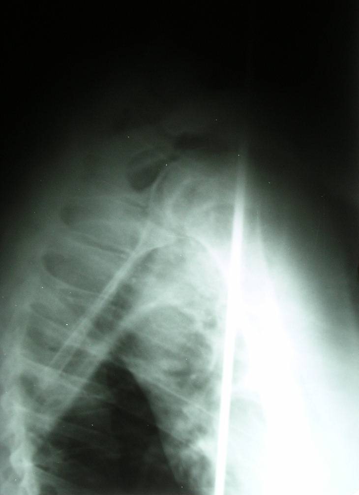Lateral X-ray of Dan Meyer