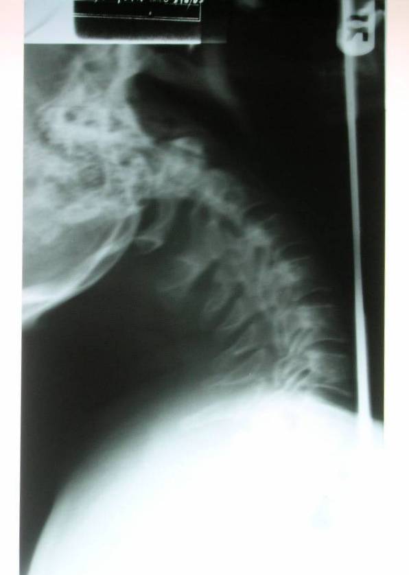 Lateral X-ray of Dan Meyer