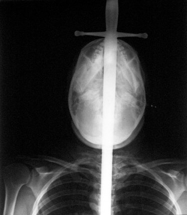 Frontal X-ray of Jewels
