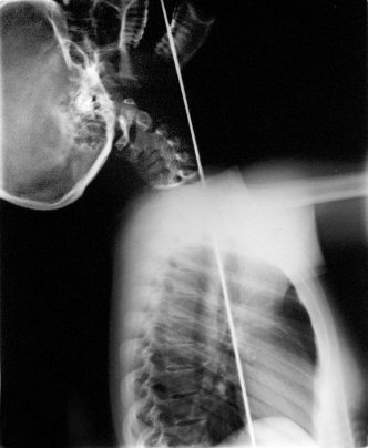 Lateral X-ray of Jewels